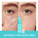 PH Balancing Toner Daily Rescue Facial Spray for Sensitive Skin Hypochlorous Acid Spray Helps Reduce Redness Breakouts Soothing